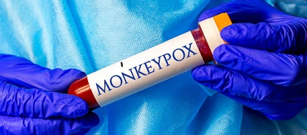 New infectious Monkeypox virus disease sample in lab tube in the scientist hand in blue medical glove on light background.