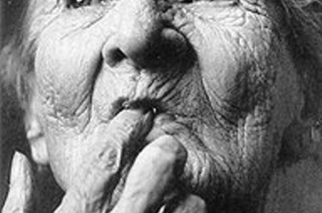 alzheimer