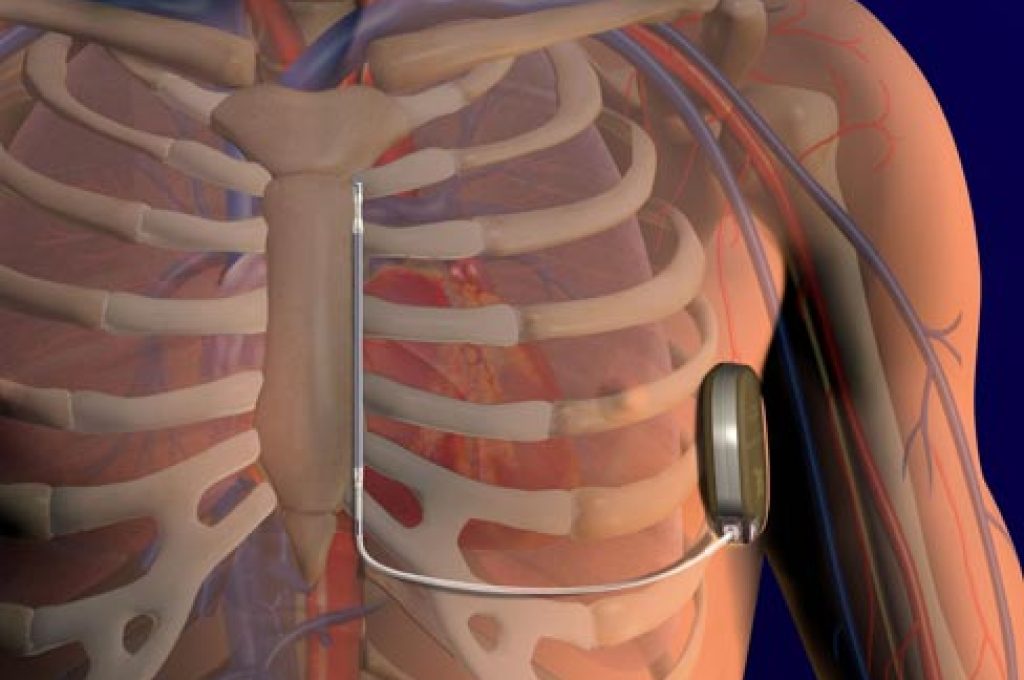defibrillatore-sottocutaneo_hg45345