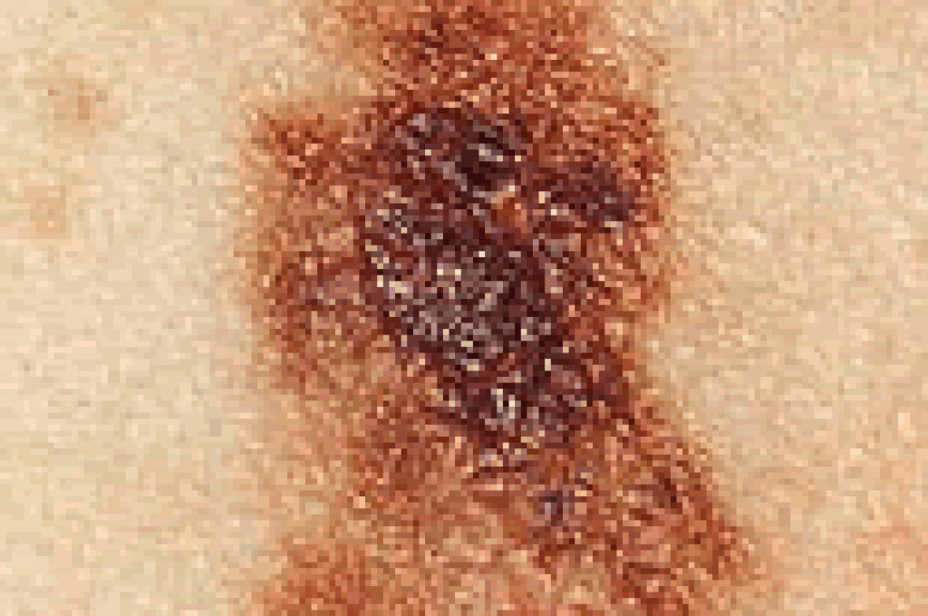 melanoma1