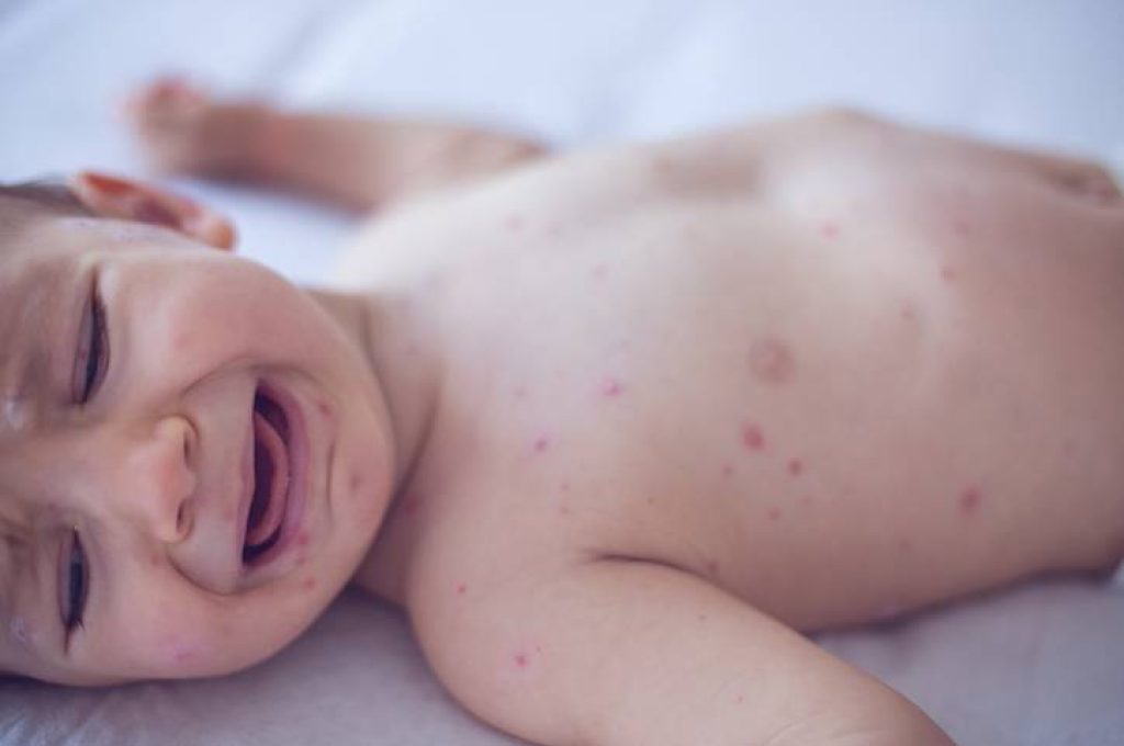 morbillo