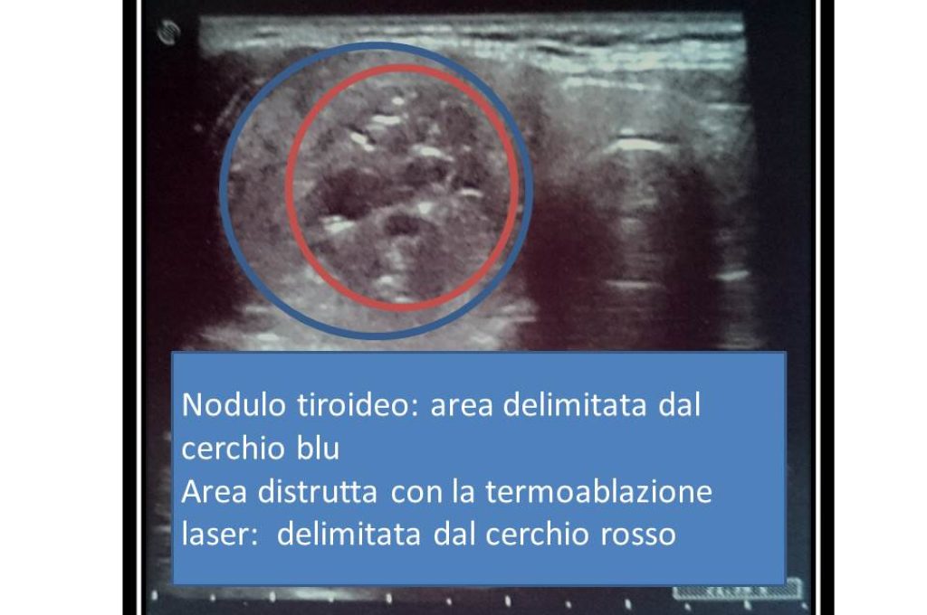 nodulo tiroide