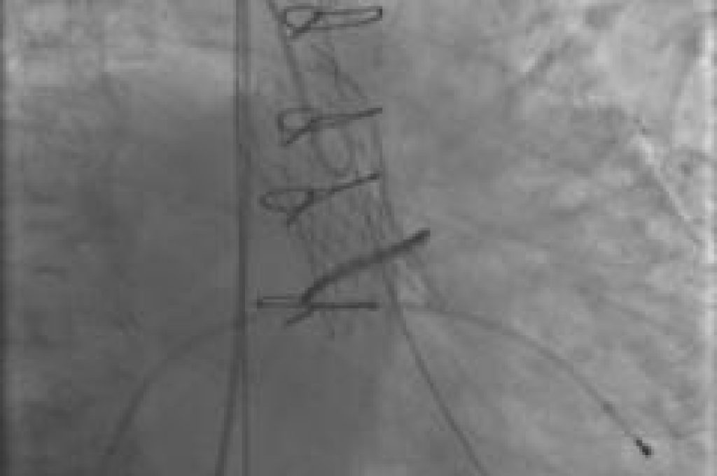 valvola cardiaca